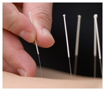 Acupuncture